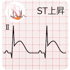 [Move!] abnormal ECG